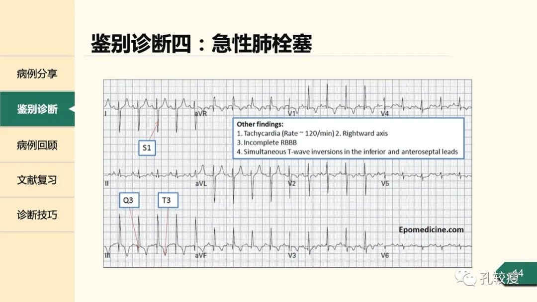 t波倒置在心电图中怎么看,T波低平心电图讲解