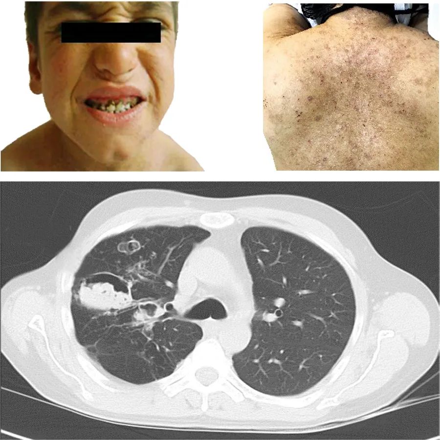 高ige综合征是免疫缺陷吗,高德地图
