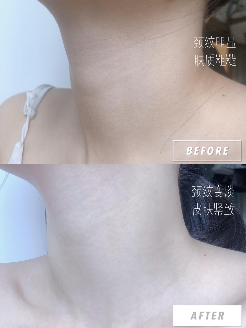 一条颈纹老十岁教你一招淡化,女人脖子有颈纹和年龄有关吗