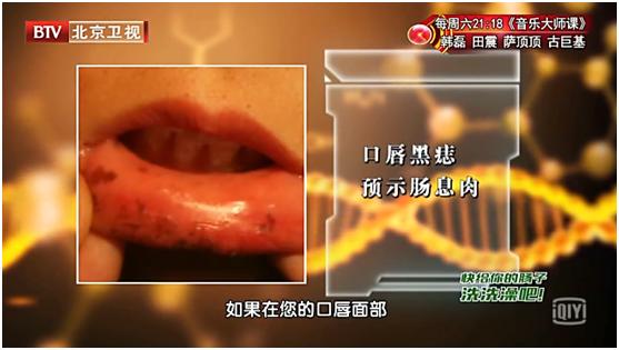 肠息肉转变癌症的概率,肠息肉会变癌吗癌有4个早期信号