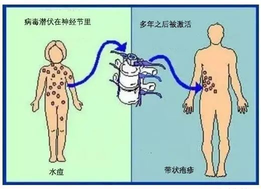 这个病终于有疫苗了,开打