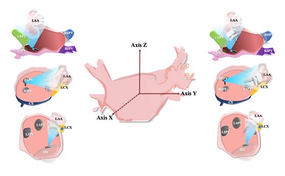 ESC2020丨储慧民团队：创新左心耳封堵之LOVE术式
