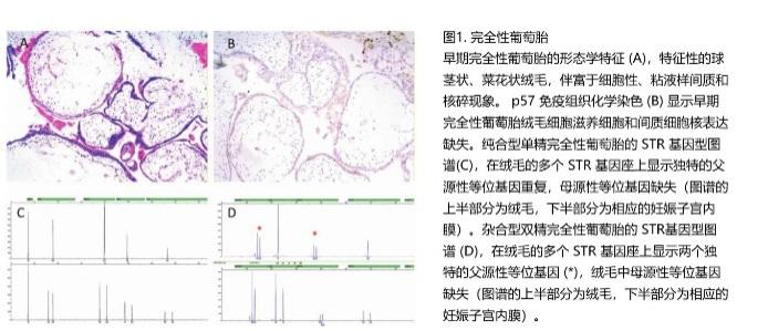 【妇产学术】北京妇产医院关于葡萄胎进展滋养细胞疾病风险研究取得新成果