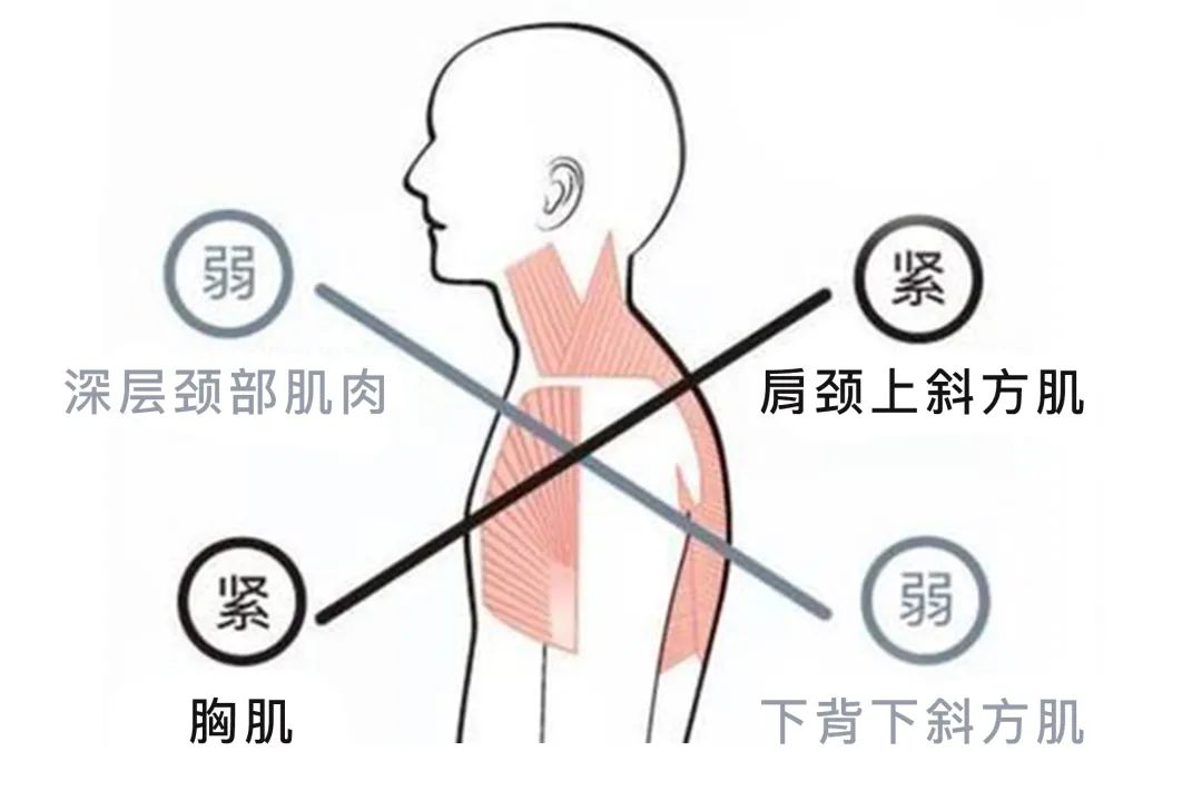 驼背平时自己注意可以改善吗,驼背如何矫正自己的气质