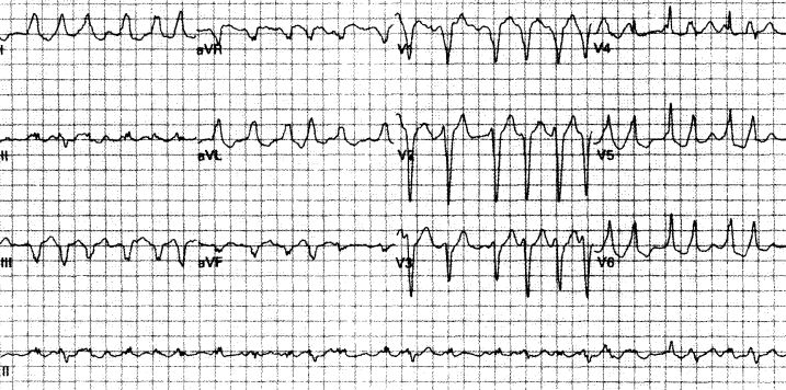 室速属于重大疾病吗,室速的相关资料