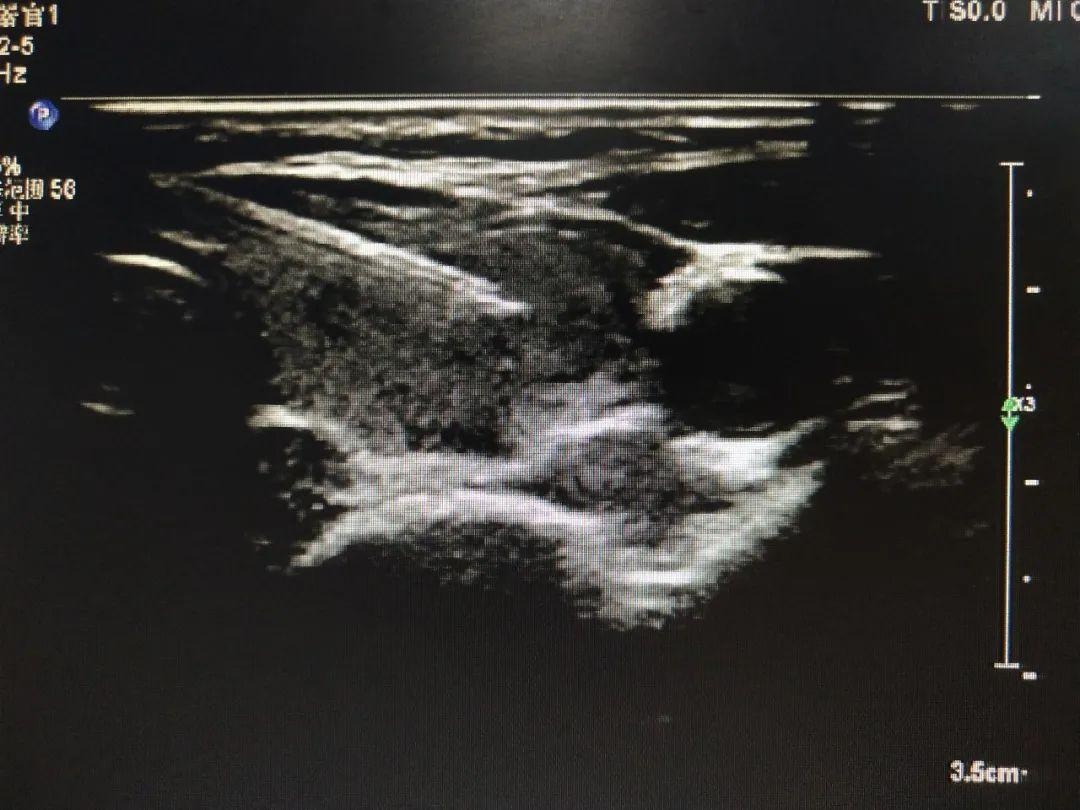 超声介入胆管引流,超声引导下胆道置管引流