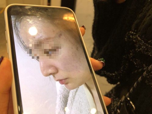 西安一女子隆鼻花费近5万,西安一女子花四万元整形