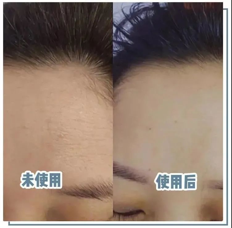 抬头纹眉间纹怎么去除,眉间纹抬头纹去除最好的方法