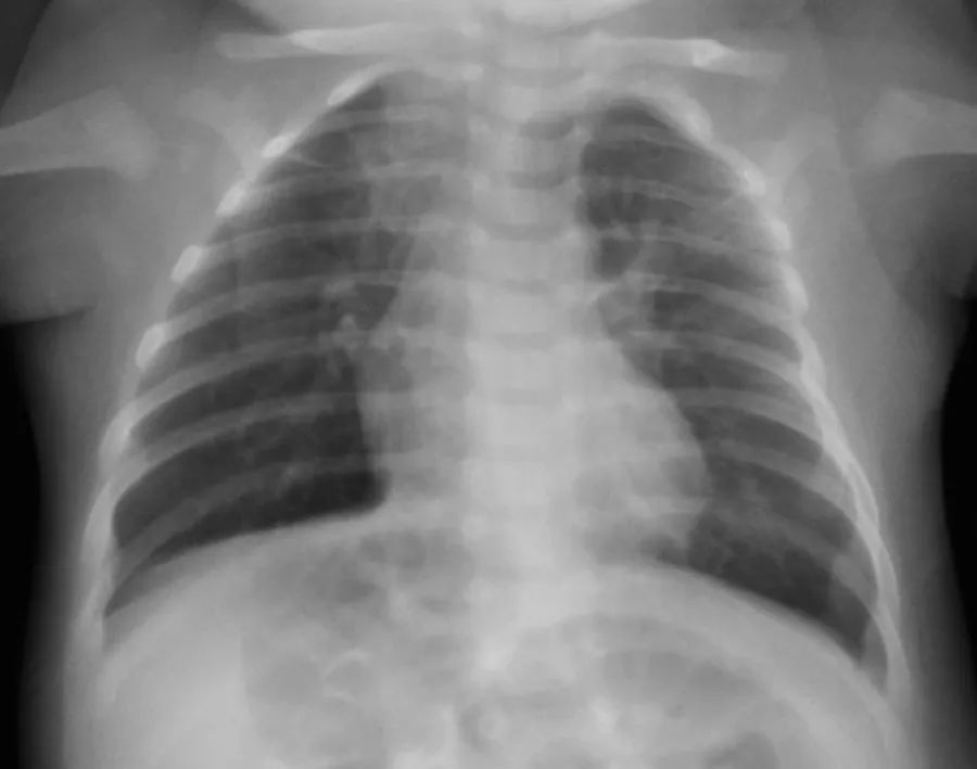 接种卡介苗后疤痕的中间有根粉刺,打了卡介苗腋下有疙瘩