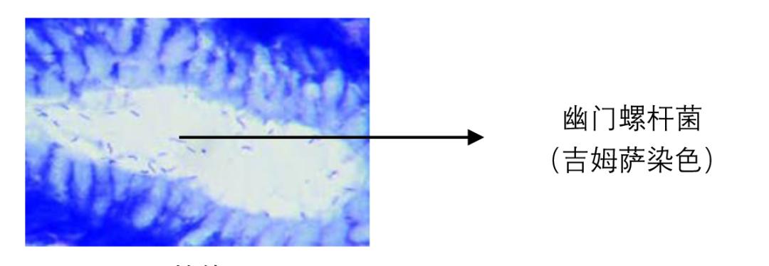 胃镜轻度肠化生到胃癌几年,胃炎肠化是怎么回事