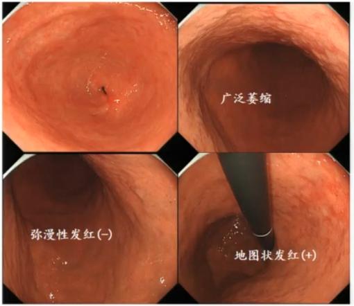 CGC2020|吕宾教授：Hp根除对胃黏膜的影响（附内镜下图像）
