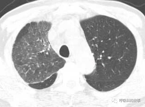 我是如何诊治肺炎的？（4）——如何理解抓住关键信息（2）