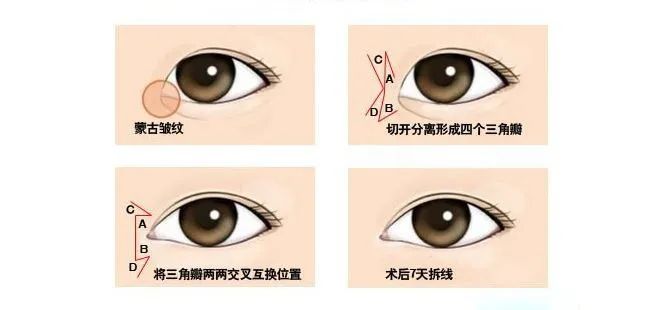 眼综合包含在眼综合吗,眼综合每个人都适合吗