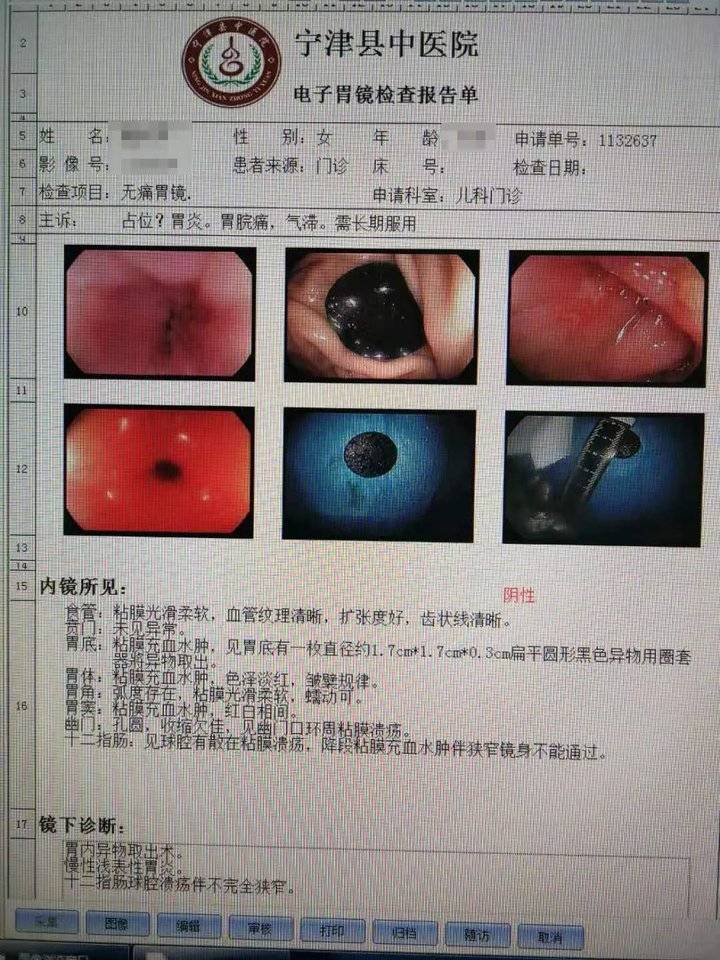 吉林一男子吃饺子误将硬币吞进肚,吃饺子吃到硬币把牙崩掉了一块
