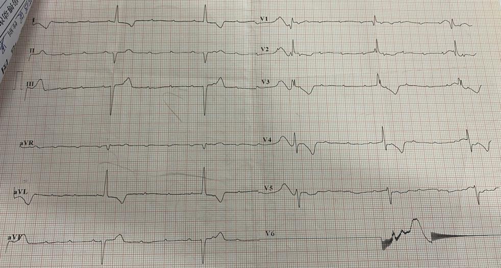 临时起搏器治疗暴发性心肌炎,七岁女孩暴发性心肌炎
