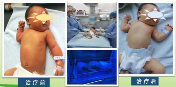 刚出生的宝宝黄疸怎么预防,新生宝宝为什么容易出现黄疸
