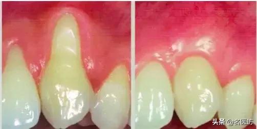 牙周炎才是牙齿松动的罪魁祸首,牙周炎导致全部牙齿脱落镶什么牙