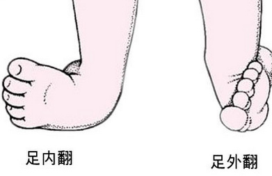 关于儿童足外翻，你误会了多少？后悔科普太晚了