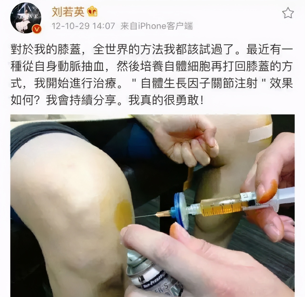 干细胞治疗骨关节炎招募患者,干细胞治疗踝关节关节炎