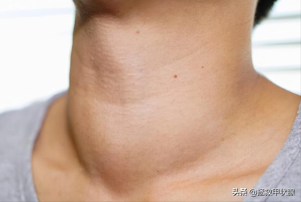 治甲状腺结节中药方子,专治甲状腺结节的中药方子