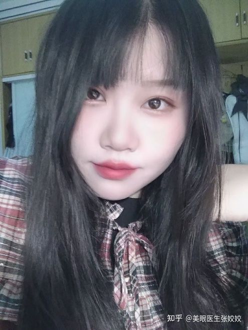 胖妹妹适合割双眼皮吗,胖女孩割双眼皮