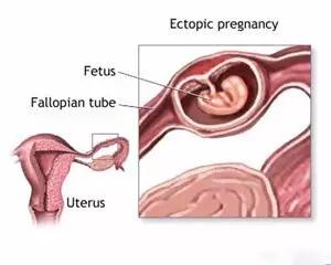 早孕试纸可以观察hcg吗,早孕期超声筛查是免费的吗