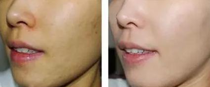 激光美白祛斑淡化斑点并去除皱纹,牙齿内源性变色用激光美白有用吗