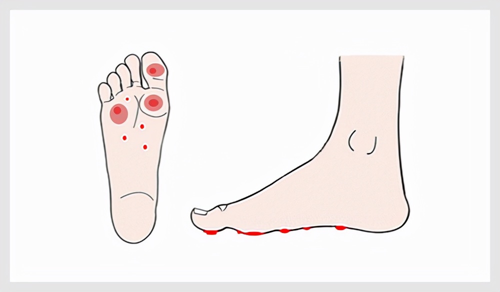 脚上长了跖疣能自愈吗,跖疣冷冻后变刺瘊
