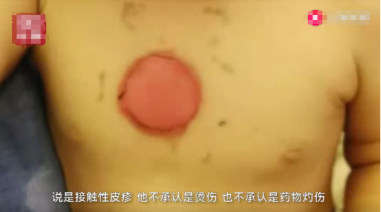 贵阳小孩子贴敷被灼伤,小孩贴三伏贴红肿起泡正常吗