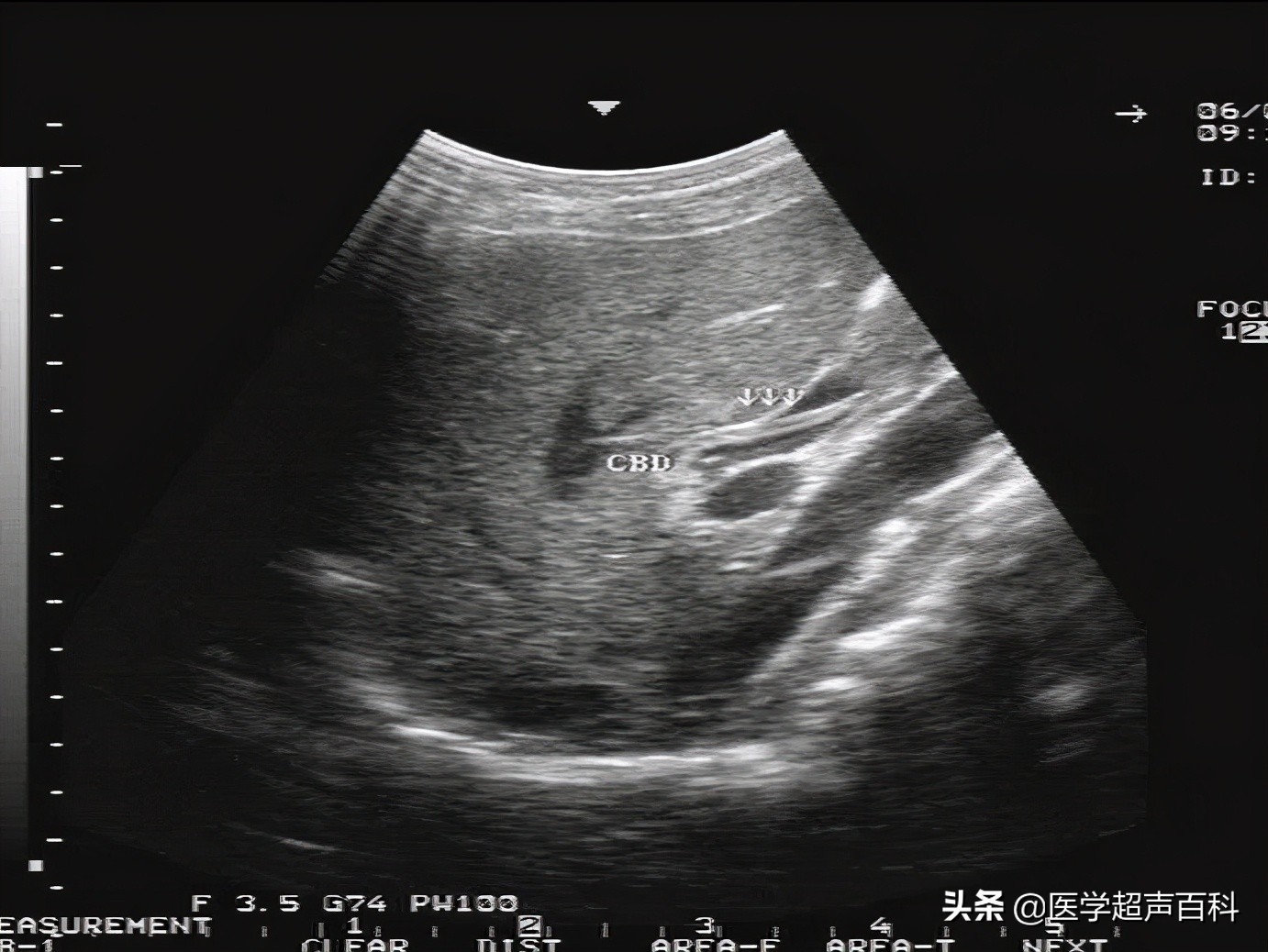 胆道蛔虫病超声表现,超声诊断胆囊疾病图像