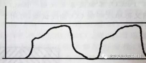 常见呼吸类型有哪几种,呼吸少量二氧化碳有什么症状