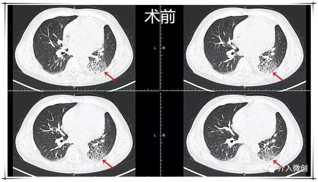 肺神经内分泌癌早期手术好吗,肺部神经内分泌肿瘤治疗