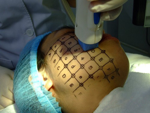 无创医美项目详解:热玛吉到底是啥?有什么副作用么?