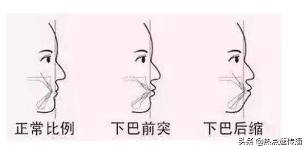 导致下巴歪的原因有哪些,下巴后缩严重的案例
