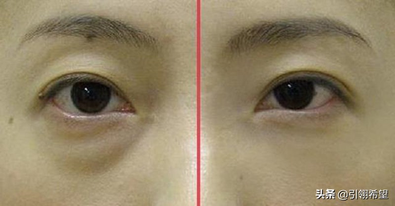 10年的眼袋终于有救了,告别困扰多年的眼袋