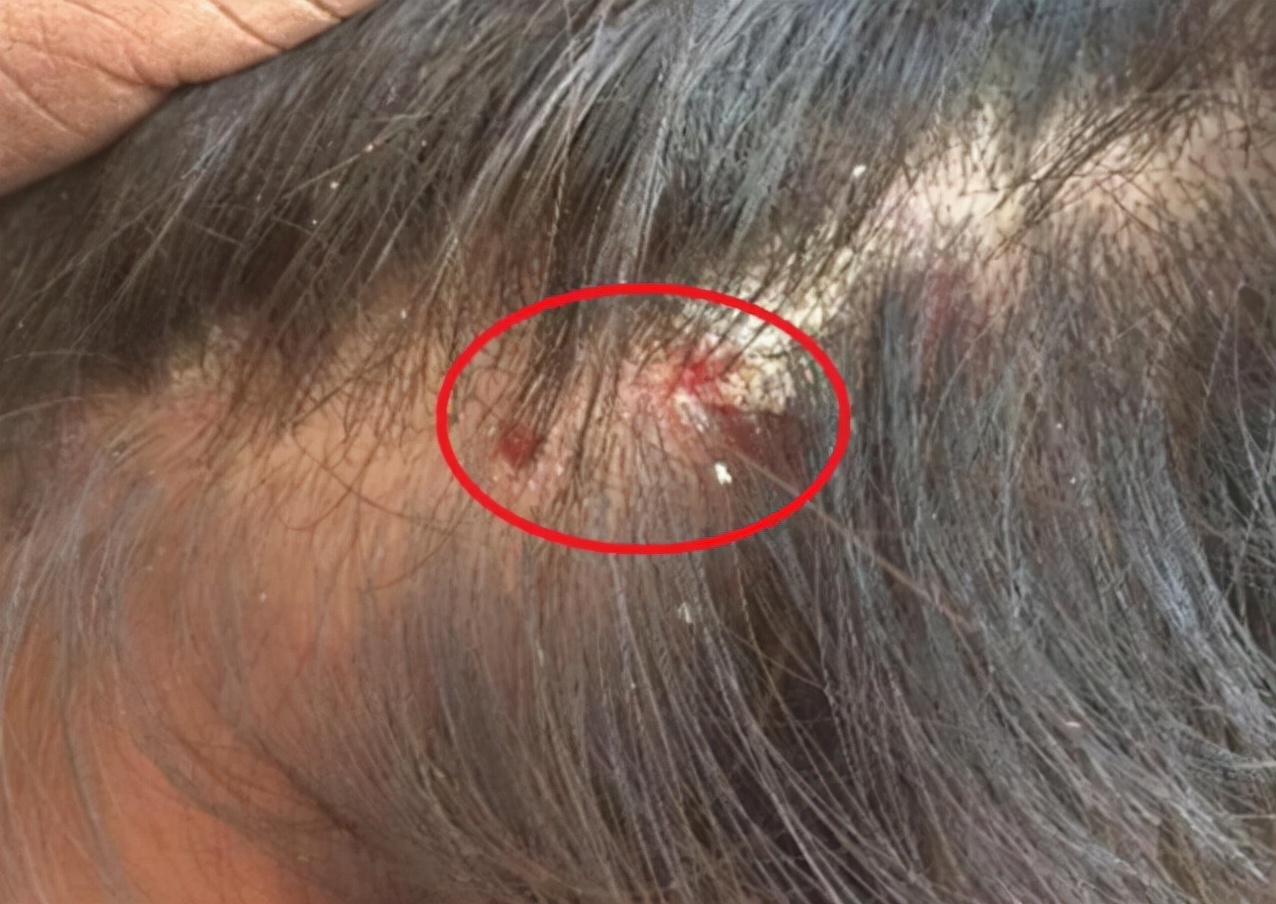 头皮上总出油长有疙瘩或脓包,头皮老是长疙瘩是咋回事