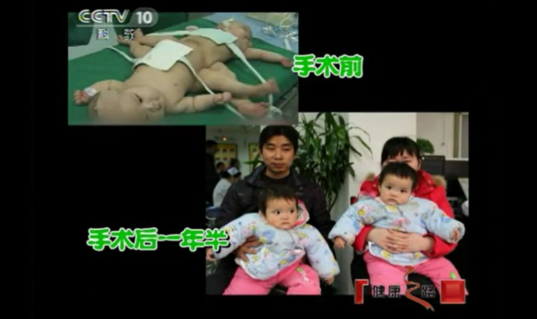 10年前的今天，这对罕见的连体女婴成功“分身”，如今她们牵手上学超暖心