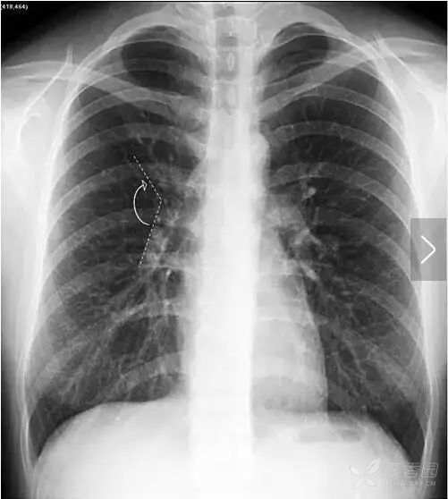 正常胸片图片,正常的胸片讲解