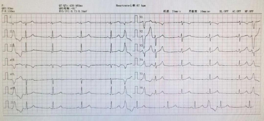 扩心病引起的早搏能治好吗,什么药治早搏