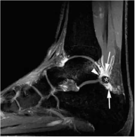 踝关节撞击症问诊,踝关节内侧撞击综合症位置图
