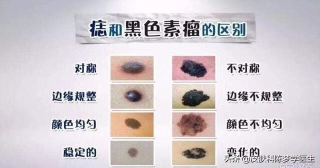 激光点痣真的会导致痣发生癌变吗,脸上有痣能激光点痣吗