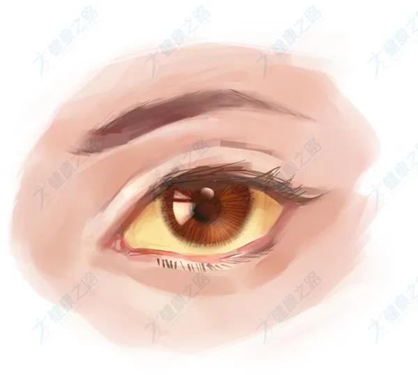 眼白变黄会癌变吗,眼白充血要警惕四种疾病