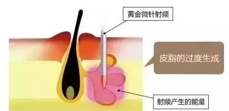 脸上不同部位长痘对应器官有问题,脸上长痘部位对应内脏