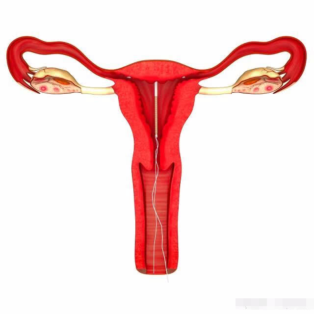 备孕二胎取节育环在什么时间最好,取节育环后多久可以怀孕最佳