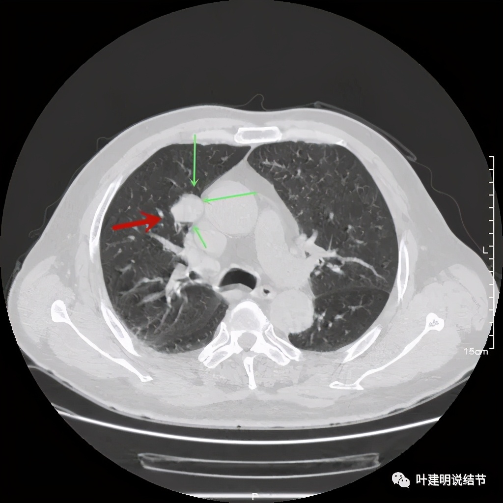 误诊报告图片,误诊案例及案例分析