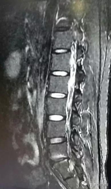腰突椎间孔镜手术后复发怎么办,腰突做椎间孔镜手术到底好不好