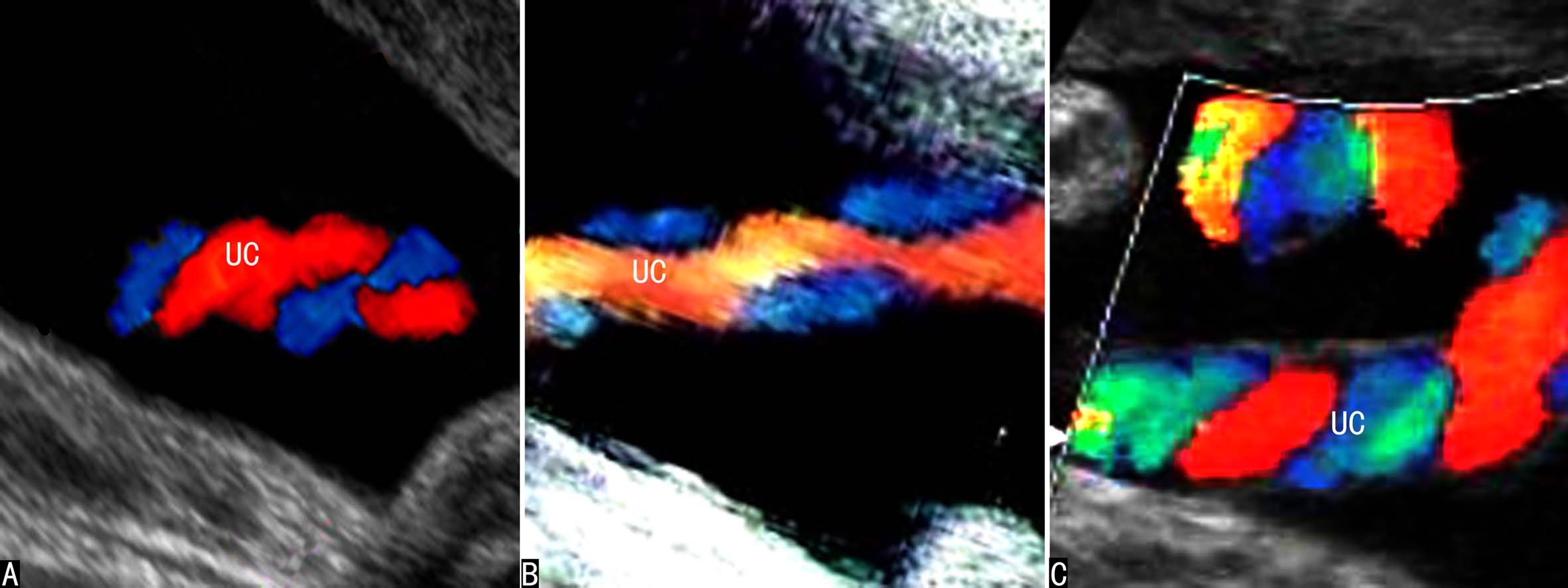 做高清彩超能看出脐带扭转吗,脐带超声异常