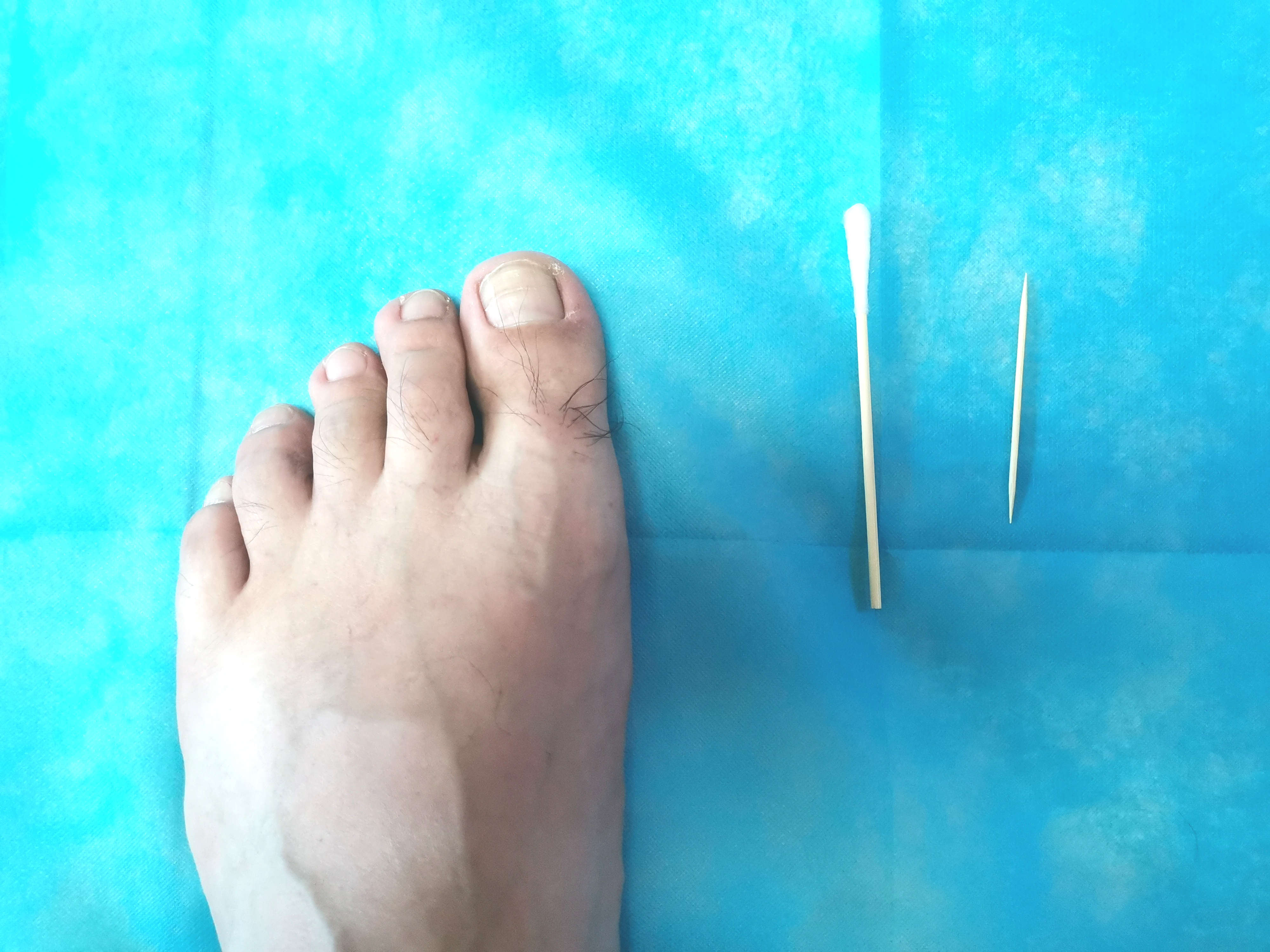 甲沟炎塞棉花能永久治疗甲沟炎吗,如何用棉花棒治疗甲沟炎