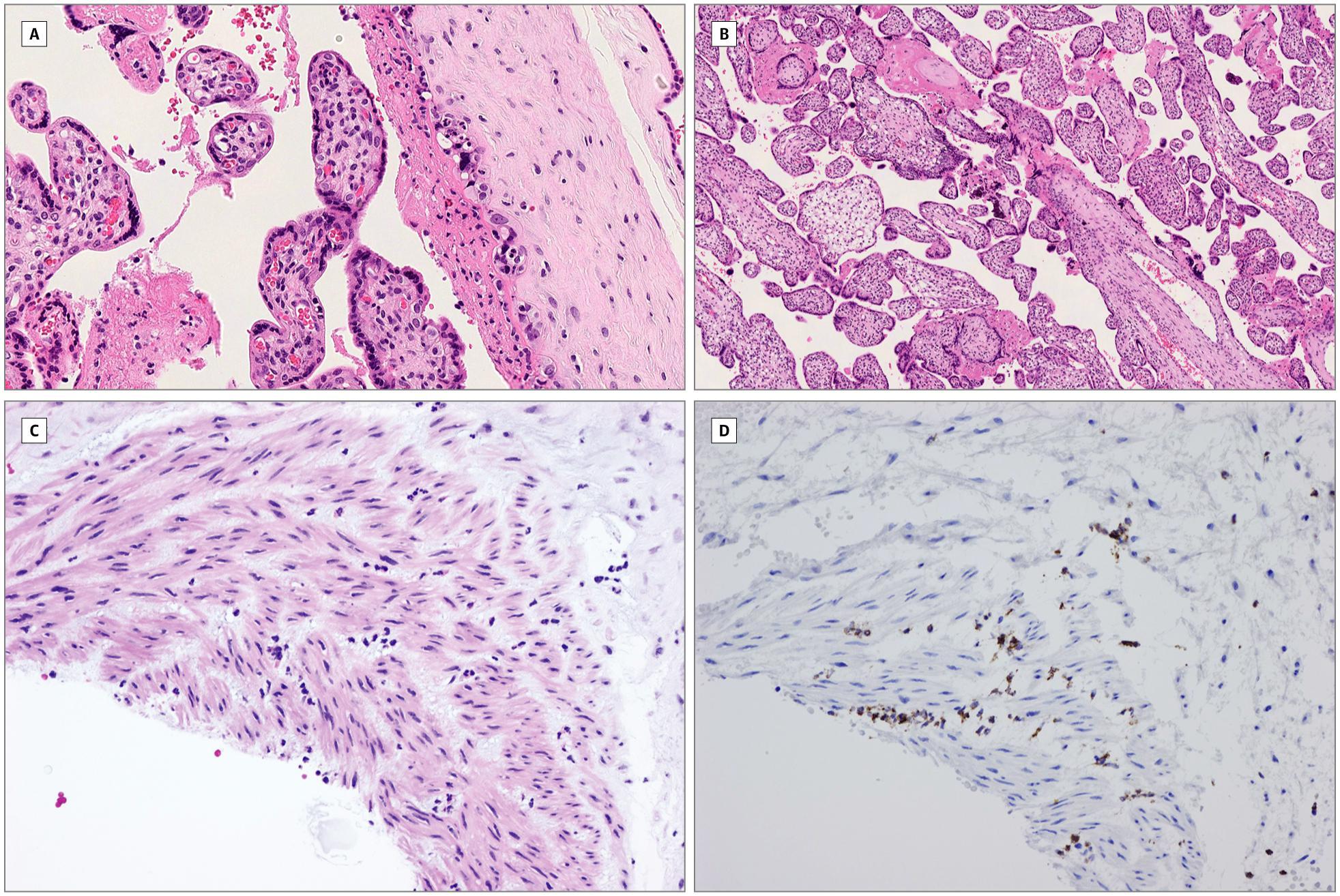 新冠导致孕妇流产案例,新冠疫情中孕妇流产事件
