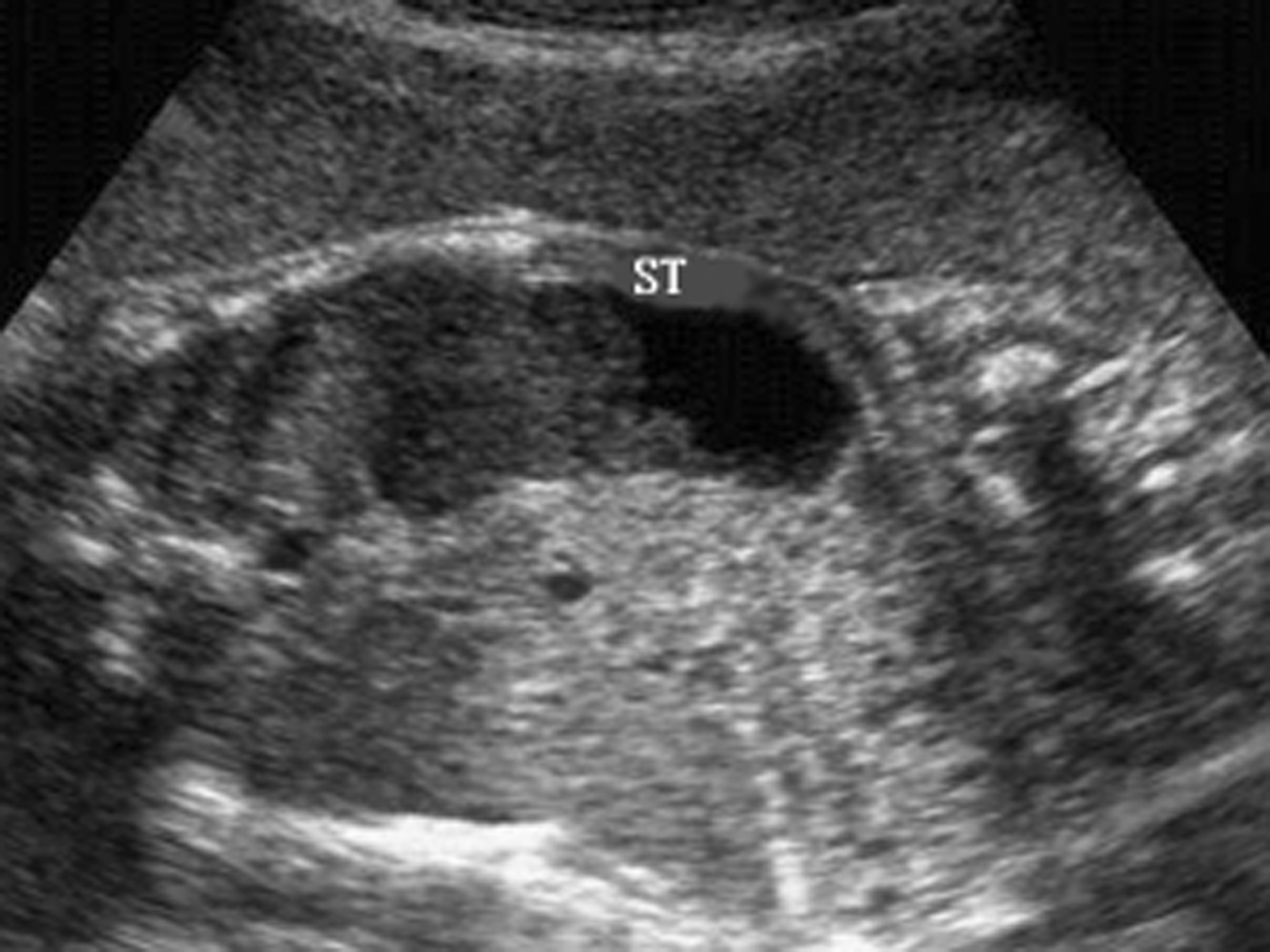 超声能检查出胎儿消化系统畸形吗,胎儿消化系统畸形怎么查